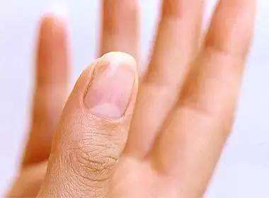 指甲上的月牙数量等于你的健康状况吗
