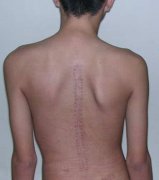 <b>脊柱侧弯患者症状图</b>